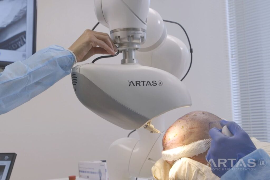 ARTAS Robotic Hair Transplant System - Coastal Dermatology Institute